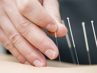 dry needling